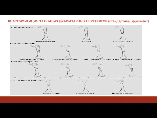 КЛАССИФИКАЦИЯ ЗАКРЫТЫХ ДИАФИЗАРНЫХ ПЕРЕЛОМОВ (стандартная, фрагмент)