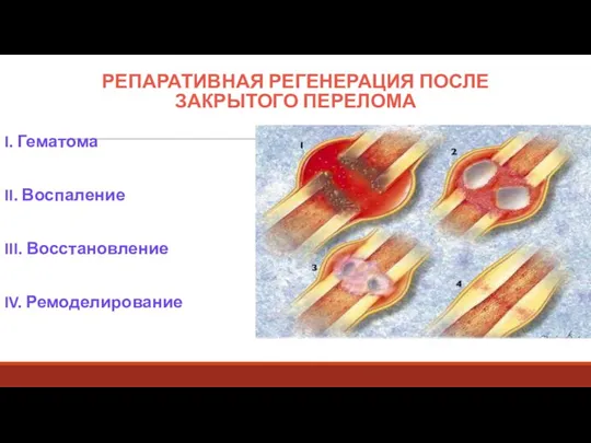 РЕПАРАТИВНАЯ РЕГЕНЕРАЦИЯ ПОСЛЕ ЗАКРЫТОГО ПЕРЕЛОМА I. Гематома II. Воспаление III. Восстановление IV. Ремоделирование