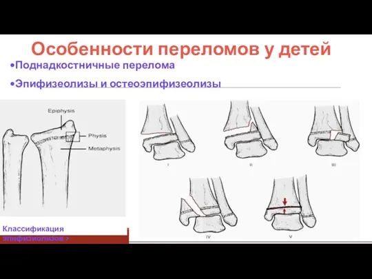 Особенности переломов у детей Поднадкостничные перелома Эпифизеолизы и остеоэпифизеолизы Классификация эпифизиолизов >