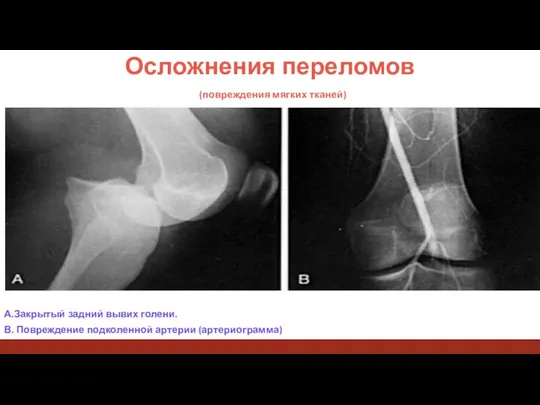 Осложнения переломов (повреждения мягких тканей) А.Закрытый задний вывих голени. В. Повреждение подколенной артерии (артериограмма)