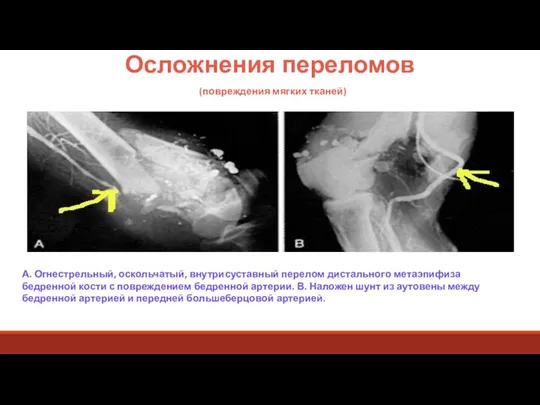 Осложнения переломов (повреждения мягких тканей) А. Огнестрельный, оскольчатый, внутрисуставный перелом