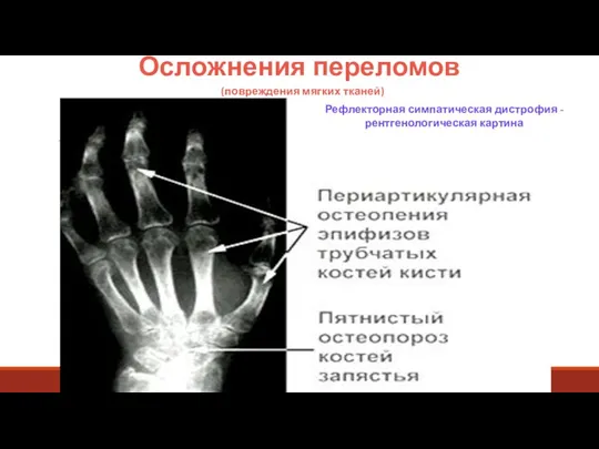 Осложнения переломов (повреждения мягких тканей) Рефлекторная симпатическая дистрофия - рентгенологическая картина