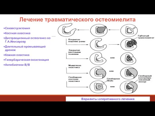 Лечение травматического остеомиелита Секвестрэктомия Костная пластика Дистракционный остеогенез по Г.А.Илизарову