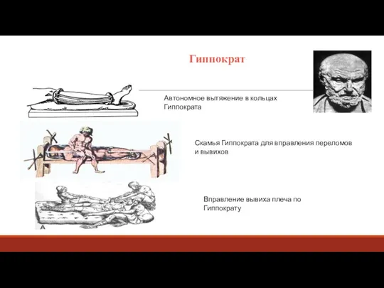Гиппократ Автономное вытяжение в кольцах Гиппократа Скамья Гиппократа для вправления