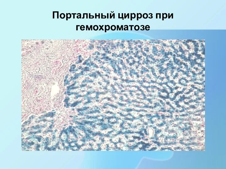 Портальный цирроз при гемохроматозе