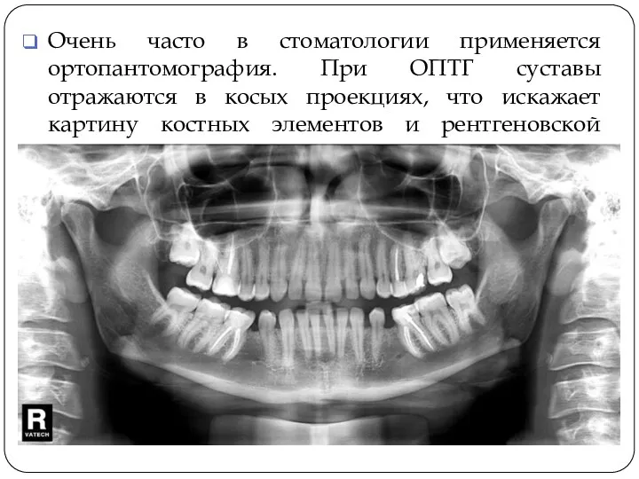 Очень часто в стоматологии применяется ортопантомография. При ОПТГ суставы отражаются в косых проекциях,