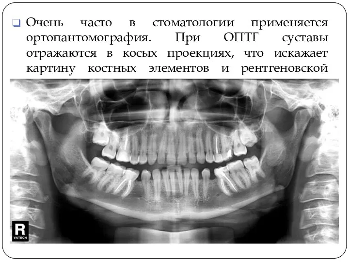 Очень часто в стоматологии применяется ортопантомография. При ОПТГ суставы отражаются