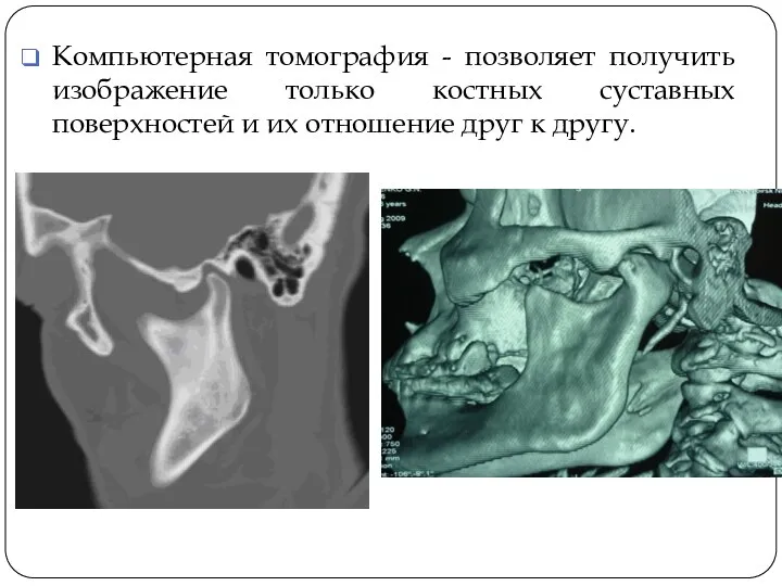 Компьютерная томография - позволяет получить изображение только костных суставных поверхностей и их отношение друг к другу.