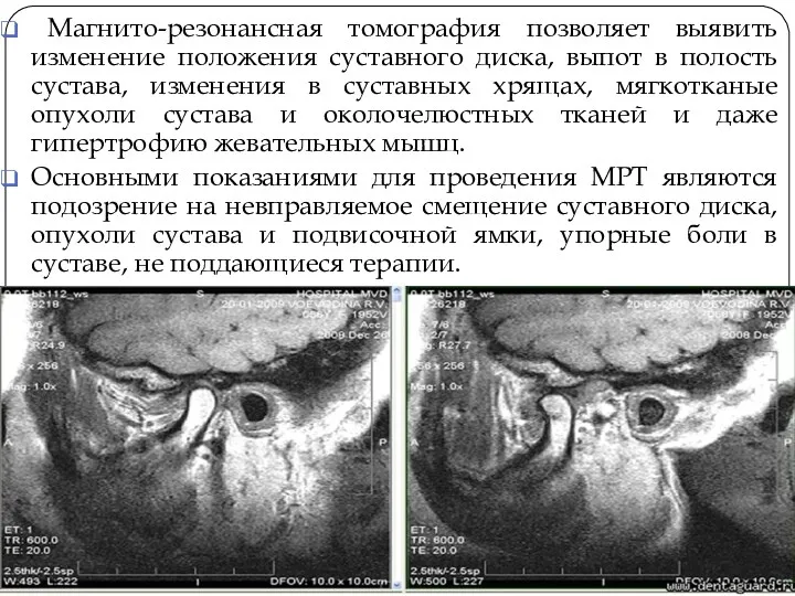 Магнито-резонансная томография позволяет выявить изменение положения суставного диска, выпот в