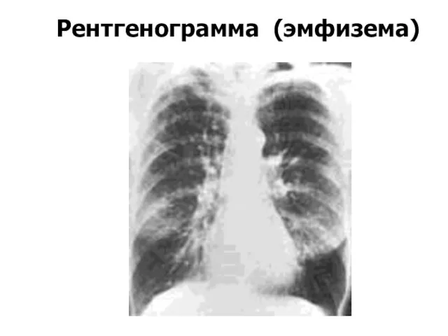 Рентгенограмма (эмфизема)