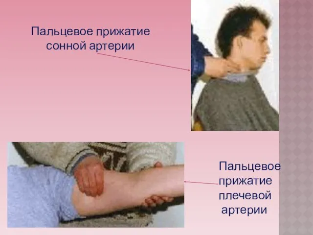 Пальцевое прижатие сонной артерии Пальцевое прижатие плечевой артерии