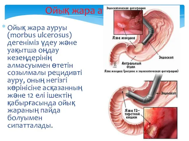 Ойық жара ауруы Ойық жара ауруы (morbus ulcerosus) дегеніміз үдеу