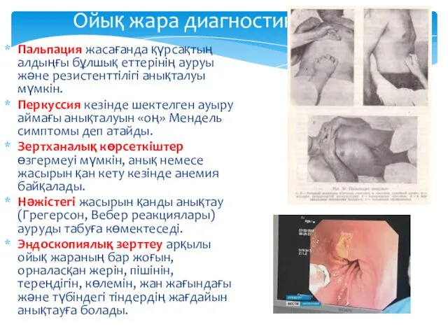 Ойық жара диагностикасы Пальпация жасағанда қүрсақтың алдыңғы бұлшық еттерінің ауруы