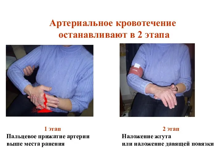 Артериальное кровотечение останавливают в 2 этапа 1 этап Пальцевое прижатие артерии выше места
