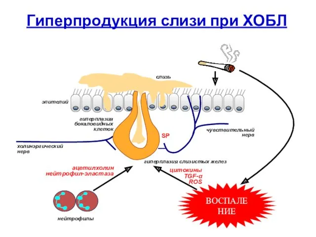 SP гиперплазия бокаловидных клеток слизь холинэргический нерв ацетилхолин нейтрофил-эластаза нейтрофилы эпителий цитокины TGF-α