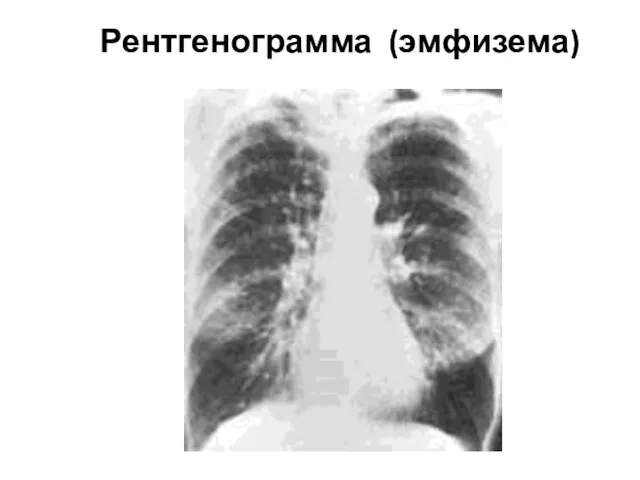 Рентгенограмма (эмфизема)
