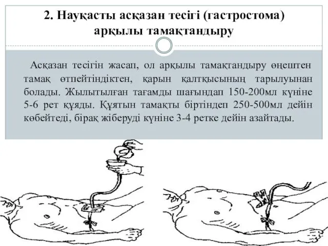 2. Науқасты асқазан тесігі (гастростома) арқылы тамақтандыру Асқазан тесігін жасап,