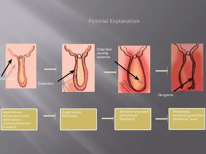 Pictorial Explanation obstruction Distention mucus Distention causing Ischemia Gangrene