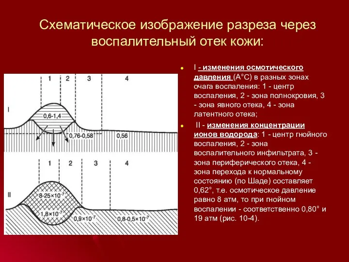 Схематическое изображение разреза через воспалительный отек кожи: I - изменения