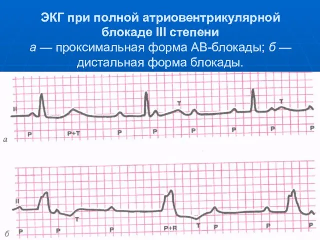 ЭКГ при полной атриовентрикулярной блокаде III степени а — проксимальная