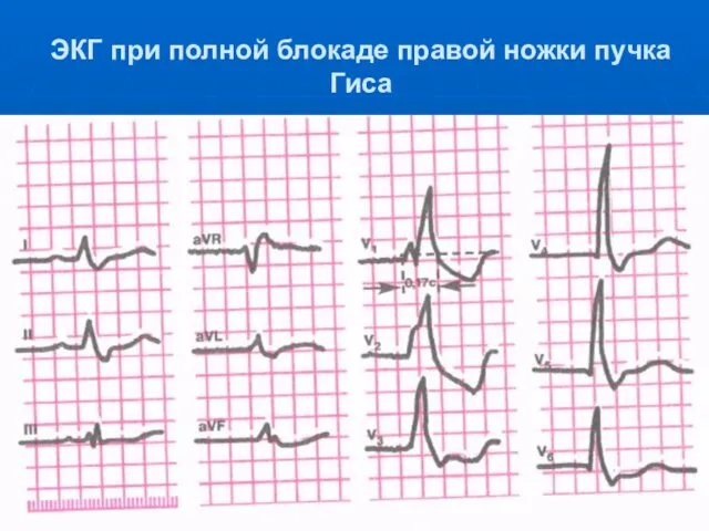 ЭКГ при полной блокаде правой ножки пучка Гиса