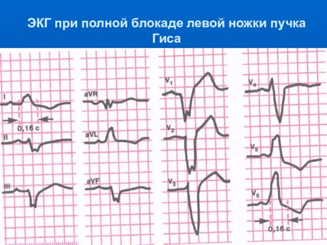 ЭКГ при полной блокаде левой ножки пучка Гиса