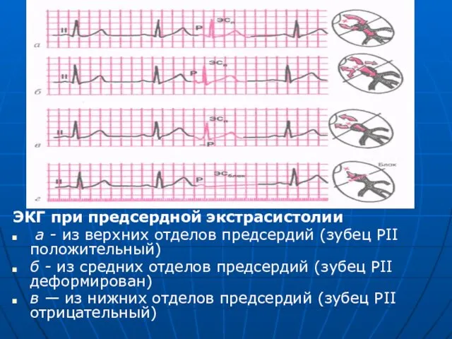 ЭКГ при предсердной экстрасистолии а - из верхних отделов предсердий