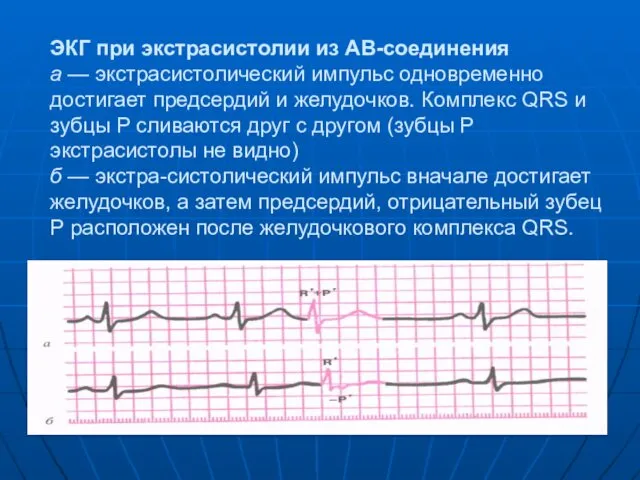 ЭКГ при экстрасистолии из АВ-соединения а — экстрасистолический импульс одновременно