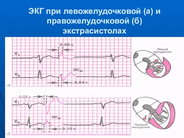 ЭКГ при левожелудочковой (а) и правожелудочковой (б) экстрасистолах