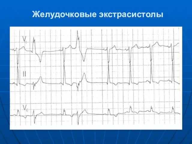 Желудочковые экстрасистолы