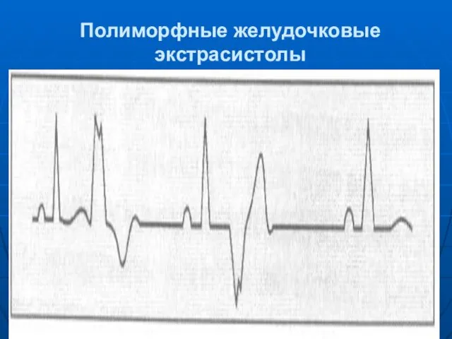 Полиморфные желудочковые экстрасистолы