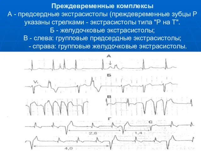 Преждевременные комплексы А - предсердные экстрасистолы (преждевременные зубцы Р указаны