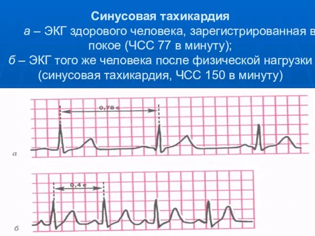 Синусовая тахикардия а – ЭКГ здорового человека, зарегистрированная в покое