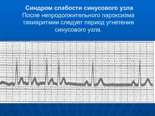 Синдром слабости синусового узла После непродолжительного пароксизма тахиаритмии следует период угнетения синусового узла.