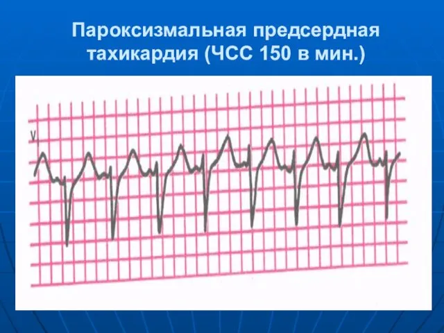 Пароксизмальная предсердная тахикардия (ЧСС 150 в мин.)