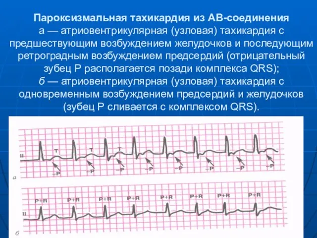 Пароксизмальная тахикардия из АВ-соединения а — атриовентрикулярная (узловая) тахикардия с