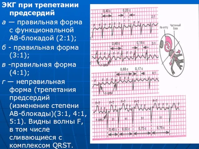 ЭКГ при трепетании предсердий а — правильная форма с функциональной