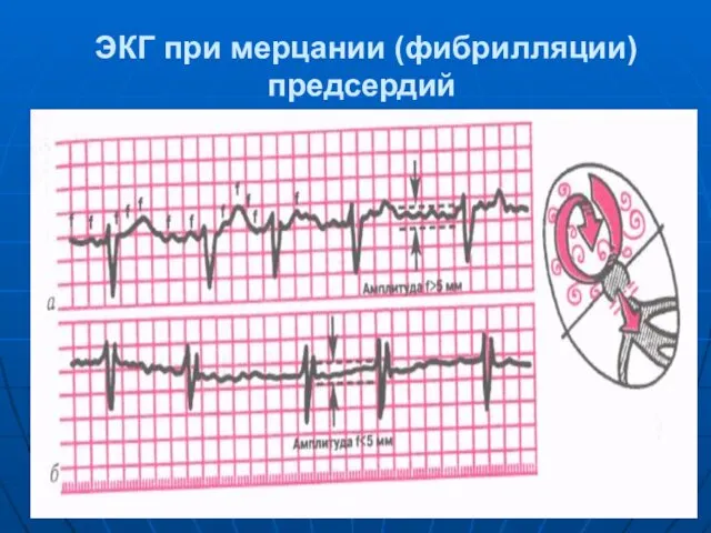 ЭКГ при мерцании (фибрилляции) предсердий