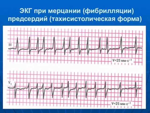 ЭКГ при мерцании (фибрилляции) предсердий (тахисистолическая форма)