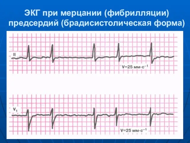 ЭКГ при мерцании (фибрилляции) предсердий (брадисистолическая форма)