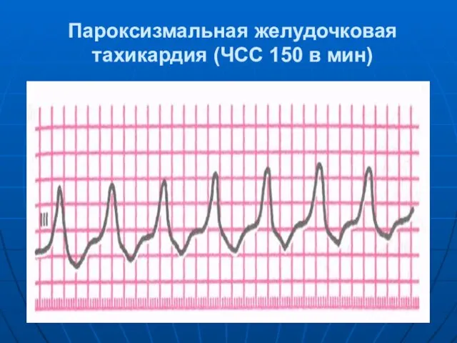 Пароксизмальная желудочковая тахикардия (ЧСС 150 в мин)