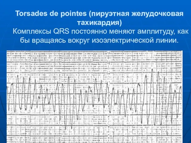 Torsades de pointes (пируэтная желудочковая тахикардия) Комплексы QRS по­стоянно меняют