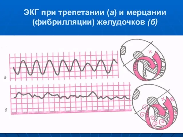 ЭКГ при трепетании (а) и мерцании (фибрилляции) желудочков (б)