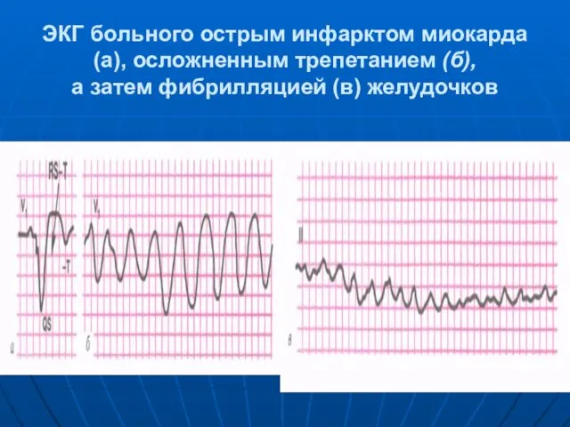 ЭКГ больного острым инфарктом миокарда (а), осложненным трепетанием (б), а затем фибрилляцией (в) желудочков