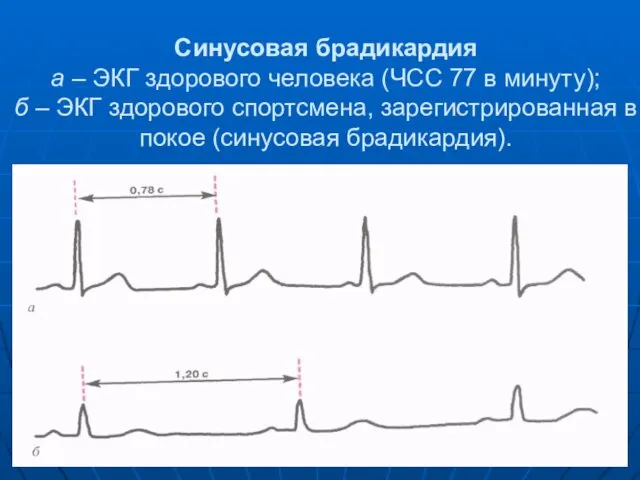 Синусовая брадикардия а – ЭКГ здорового человека (ЧСС 77 в