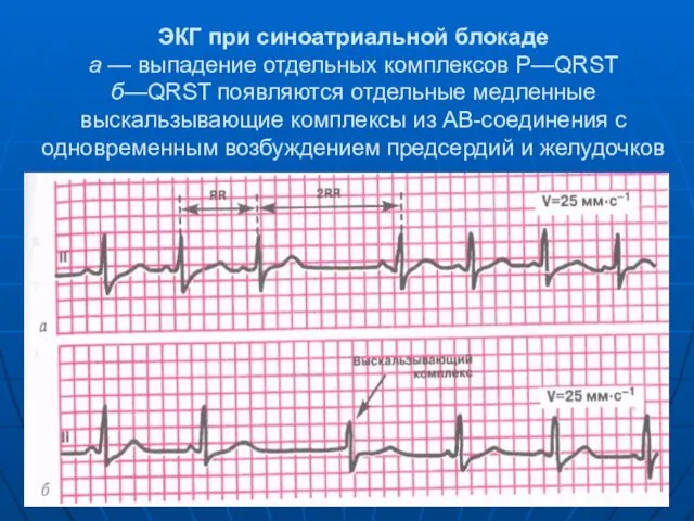 ЭКГ при синоатриальной блокаде а — выпадение отдельных комплексов Р—QRST