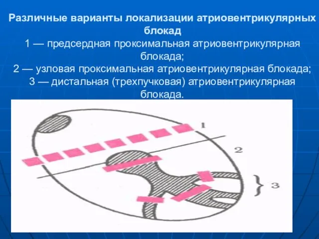 Различные варианты локализации атриовентрикулярных блокад 1 — предсердная проксимальная атриовентрикулярная