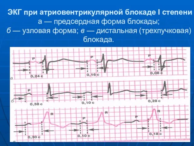 ЭКГ при атриовентрикулярной блокаде I степени а — предсердная форма