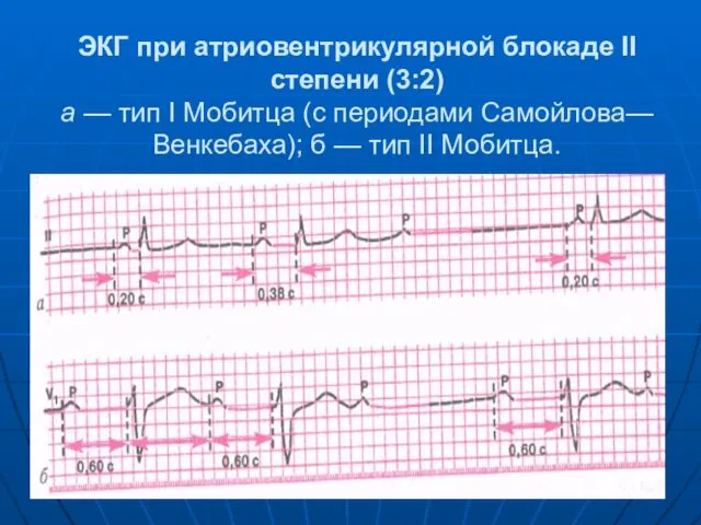 ЭКГ при атриовентрикулярной блокаде II степени (3:2) а — тип