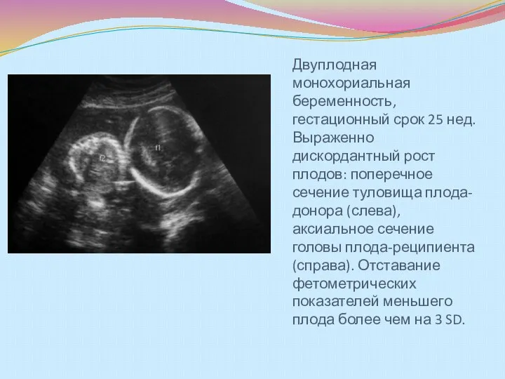 Двуплодная монохориальная беременность, гестационный срок 25 нед. Выраженно дискордантный рост
